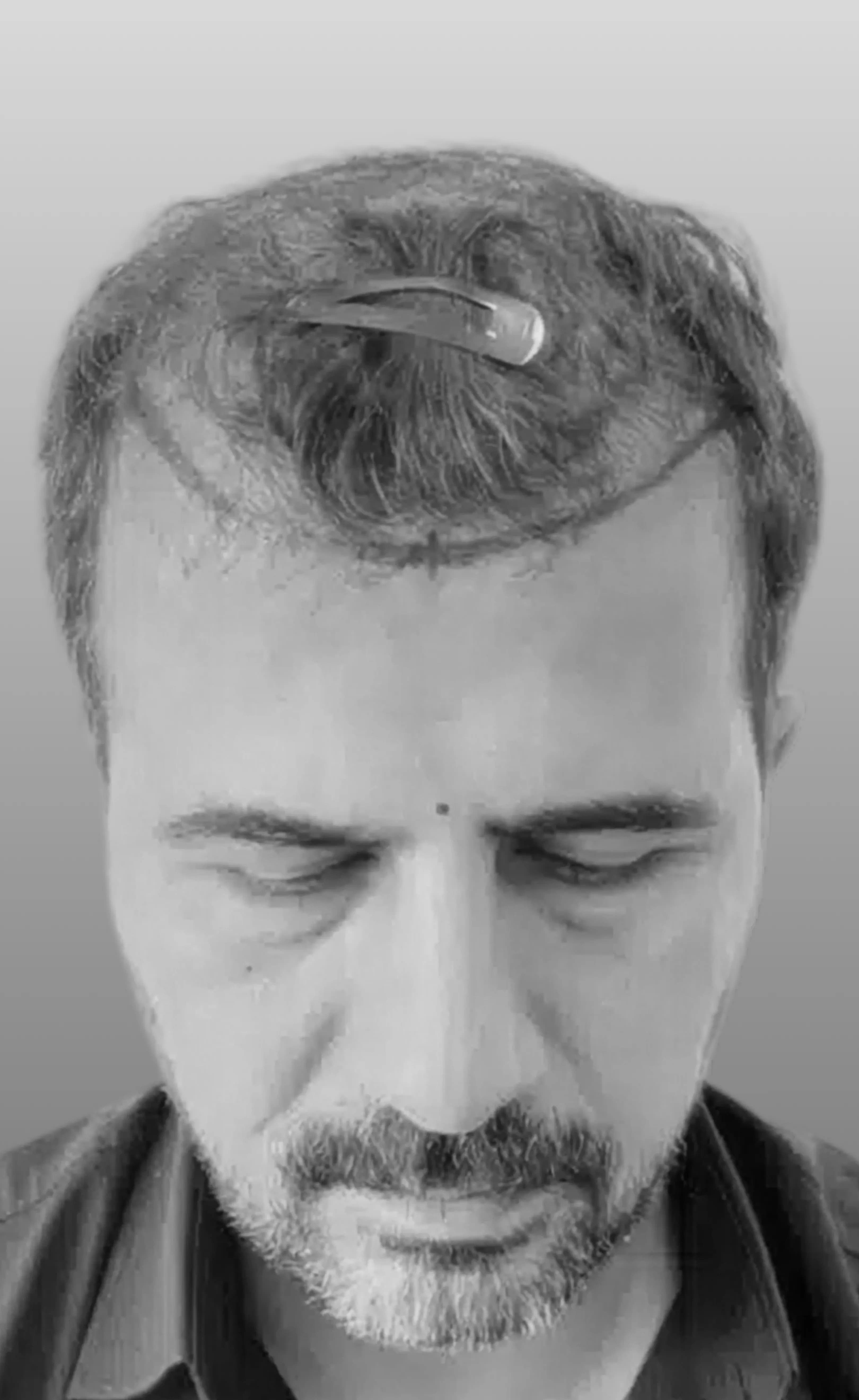 Case 03 — before treatment